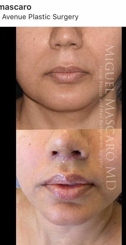 Lip Lift Surgery, Lip Lift, Facial Fillers, Nose Surgery, Facial Plastic, Aesthetic Pics, Plastic Surgery, Surgery, Aesthetic Pictures