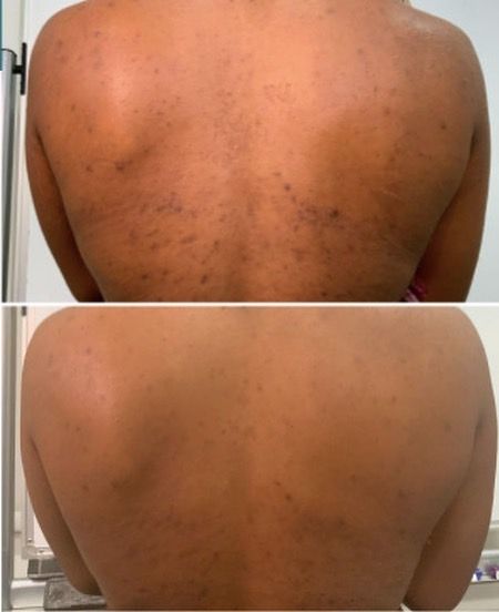 Chemical Peel Before And After Black, Chemical Peel Before And After, Vi Peel, All Skin Colors, Body Peel, Medical Aesthetician, Aesthetic Center, Retinoic Acid, Chemical Peels