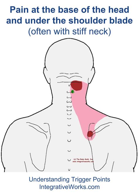 Understanding Trigger Points - Pain at the Base of the Head and Under Shoulder Blade Punkty Spustowe, Excellent Health, Stiff Neck, Upper Back Pain, Neck And Shoulder Pain, Headache Relief, Trigger Points, Massage Techniques, Shoulder Pain