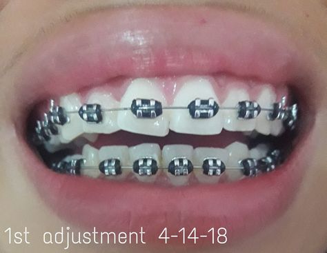 braces health aesthetic brace bracing braces cost braces for teeth bracee teeth braces teeth bracers teeth braces colors braces near me braces for straight teeth braces for teeths braces on teeth braces aesthetic brace color ideas braces colors ideas cute healthy recipes healthy cooking healthy supers healthy cook recipes healthy and delicious healthy food healthy lifestyle healthy snack healthy eats teeth whitener teeth jewelry teeth whitening with braces teeth smile teeth gems teeth color Braces With Black Bands, Braces Black Bands, Black Braces Color, Black Braces Power Chain, Black Braces Teeth, Black Braces Bands, Light Blue Braces, Power Chain Braces, Braces Colors Combinations