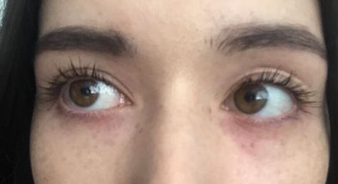 Sudden extreme redness/dryness under eyes? [skin concerns] Red Undereye Makeup Aesthetic, Under Eye Bags Aesthetic, White Undereye, Blush Under Eyes, Red Under Eye, Eye Bags Aesthetic, Red Undereye, Bright Under Eye, Pregnancy Products