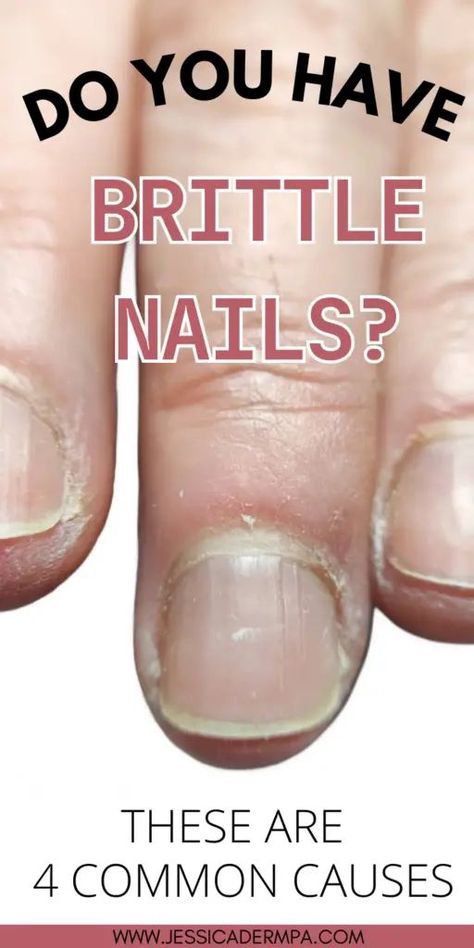 fungal nail treatment remedies Toe Nail Fungal Infection, Dermatology Physician Assistant, Take Off Acrylic Nails, Strong Healthy Nails, Nail Disorders, Nail Remedies, Nail Infection, Nail Fungus Remedy, Weak Nails