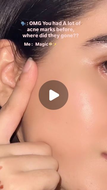 Zarnab🤍 | Yes its true , Acne marks ko ap hamesha k leay by by kr skty and can get glass skin , srf remedies use kr k😍♥️✨  I started series of daily... | Instagram Homemade Remedy For Acne, Remedies For Acne Marks, Remedy For Acne Marks, Products For Acne Marks, Acne Marks Remedies, Daily Skin Care Routine Steps, Acne Pictures, Acne Prone Skin Care Routine, Honey Skin Care