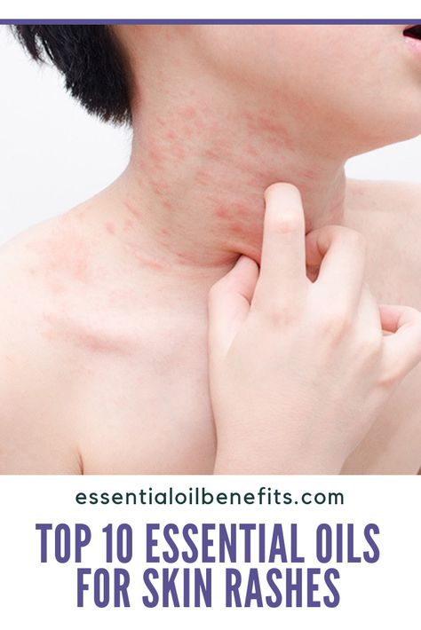 Essential Oil Recipes For Skin Rashes, Essential Oils For Rashes Skin, Essential Oils For Itching Skin, Essential Oil For Skin Irritation, Natural Remedies For Rashes, Essential Oils For Itchy Rash, Essential Oils For Rash And Itching, Essential Oils For Itchy Skin, Essential Oils For Rash