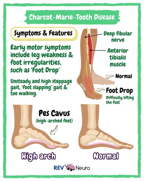 So which lesson will it be? Seizures or Strokes? Comment below ⤵️ 🧠 We are providing high quality - illustrated in house medical education. Here you have topics in Neuro. Be sure to follow for more 👉🏼 @rev.neuro Charcot - Marie - Tooth (CMT) Disease ✅ Overview Charcot-Marie-Tooth Disease (CMT) is a spectrum of nerve disorders and the most common type of heredity neuropathy. CMT causes muscle weakness and reduction in size (atrophy), and some loss of sensation in the lower legs and feet. S... Neuro Anatomy, Muscle Diseases, Nerve Disorders, Teeth Diseases, Family Nurse Practitioner, Study Essentials, Disease Symptoms, Muscle Weakness, Medical Studies