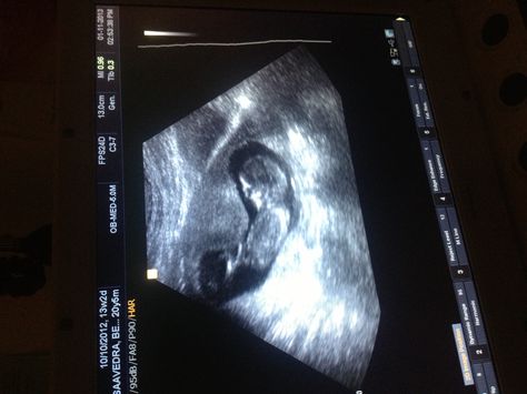 Our first ultrasound 😊 You won our heart at the first sound of the beat of your heart 😍 Ultrasound Video, Baby Heart Beat, First Ultrasound, Baby Heart, Heart Beat, Ultrasound, In A Heartbeat, Baby Stuff, The First