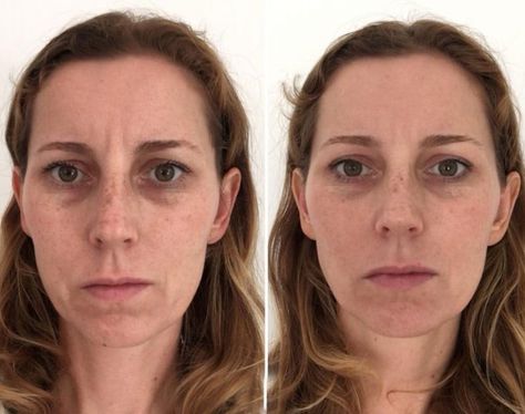 Face Yoga Before and After Images – Face Yoga Australia Face Yoga Results Before And After, Facial Yoga Before And After, Yoga Before And After, Face Yoga Before And After, Facial Before And After, Yoga Transformation, Face Yoga Method, Face Yoga Exercises, Yoga Inspo