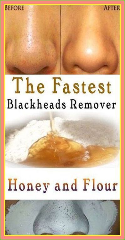 Remove Blackheads From Nose, Blackhead Remedies, Black Head Remover Mask, Blackheads On Nose, Black Heads, Skin Care Routine For 20s, Get Rid Of Blackheads, Remove Acne, Blackhead Remover