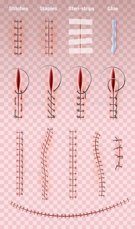 Surgical Suture Stitches Set #Suture, #Surgical, #Set, #Stitches Surgery Stitches, Medical Stitches, Medical Sutures, Stitches Medical, Surgical Stitches, Suture Techniques, Surgical Suture, Surgical Technologist, Medical Student Study