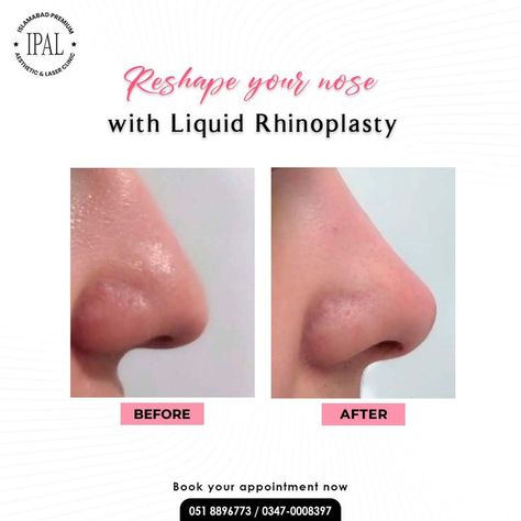 Pixie Tip Lift Nose Filler, Non Surgical Nose Job Before After, Filler Nose Job Before After, Liquid Nose Job Before And After, Nose Filler Before After Non Surgical, Liquid Rhinoplasty Before And After, Nose Filler Before After, Non Surgical Rhinoplasty, Liquid Rhinoplasty