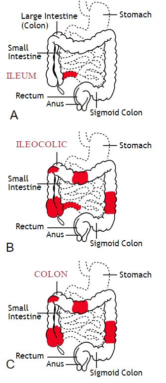 Chrones Disease, Chrons Disease, Sigmoid Colon, Types Of Diseases, Dental Cavities, Gastrointestinal Disorders, Health And Fitness Magazine, Oral Care Routine, Daily Health Tips