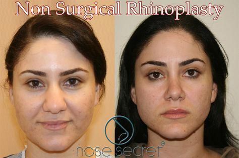 Non Surgical Nose Job, Rhinoplasty Nose Jobs, Rhinoplasty Before And After, Lip Art Makeup, Wide Nose, Nose Surgery, Celebrity Plastic Surgery, Nose Shapes, Celebrities Before And After