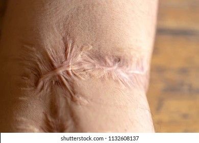 Leg Scars, Scar Healing, Hypertrophic Scars, Oils For Scars, Scar Reduction, Types Of Skin, Severe Acne, Skin Tissue, Scar Tissue