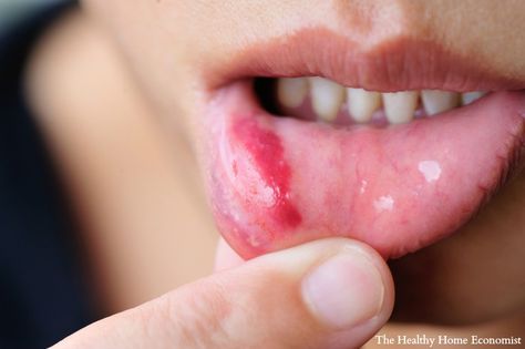 The little known cause of most canker sores that most people have no idea about. Simple avoidance can literally result in you never having one again! Pimples On Forehead, Reflexology Points, Blind Pimple, Pimples Under The Skin, Pimples Remedies, Canker Sore, Cold Home Remedies, Cold Sore, Acne Remedies