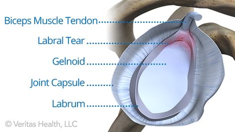 SLAP tears are common shoulder injuries in athletes participating in sports with overhead motions. What is a SLAP tear and how do you treat it? Shoulder Injury Symptoms, Torn Labrum Shoulder, Torn Rotator Cuff Symptoms, Labral Tear Shoulder, Shoulder Exercises Physical Therapy, Meniscus Injury, Shoulder Surgery Recovery, Torn Labrum, Shoulder Anatomy