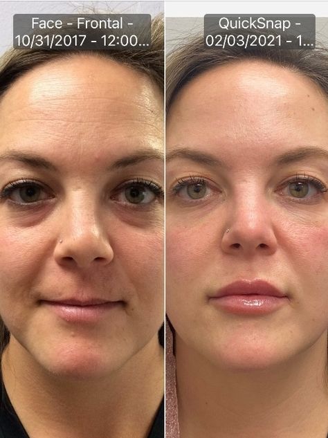 Filler Nasolabial Folds, Nasolabial Folds Dermal Fillers Before And After, Check Filler Before And After, Nasal Fold Filler Before And After, Lip Injections Before And After 1ml, Eye Trough Filler Before And After, Smile Lines Filler Before And After, Lipfiller Before After, Undereye Filler Before And After