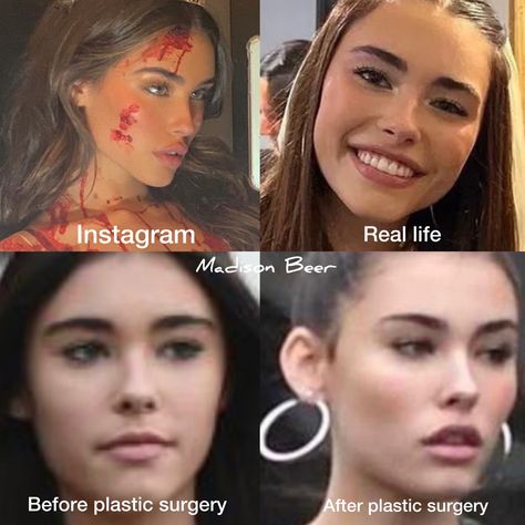 Madison Beer plastic surgery 2022 now and then natural vs after fillers and surgery Madison Beer Teeth, Before And After Plastic Surgeries, Madison Beer Before And After Surgery, Madison Beer Plastic Surgery, Acne Makeup, After Surgery, Madison Beer, Without Makeup, Iconic Women