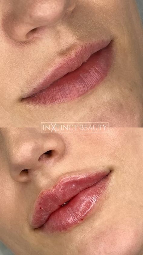 Russian Lip Technique - Lip Augmentation, Lip Filler NYC Before And After Lip Fillers Small Lips, Russian Lips Filler Natural, Lip Filler With Cupids Bow, Natural Russian Lips, Defined Cupids Bow Lip Filler, Small Lips Filler, Russian Doll Lip Filler, Natural Lip Fillers Small Lips, Down Turned Lips