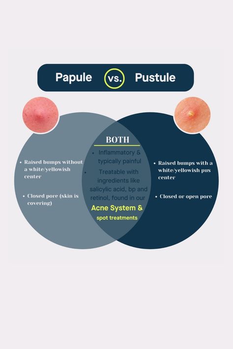 NOT ALL PIMPLES ARE POPPABLE 📣 Learn the differences between PAPULES and PUSTULES and how to treat them in our blog.⁠ Papules Acne, Types Of Pimples, Nose Pimples, Pimple Causes, Covering Acne, Inflammatory Acne, Salicylic Acid Cleanser, Mild Acne, Post Inflammatory Hyperpigmentation