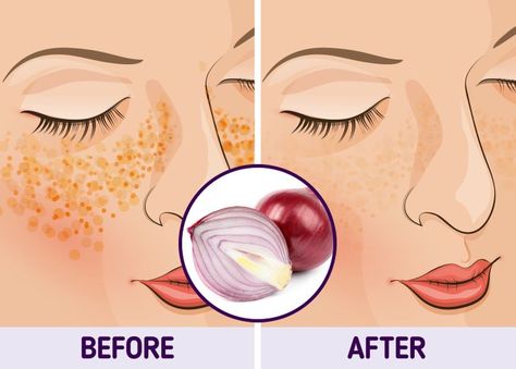 Natural Remedies For Pigmentation Faces, Reduce Pigmentation On Face, Dark Patches On Face, Face Pigmentation, Pigmentation Remedy, Korean Cream, Aloe Vera Cream, Cow Face Pose, Shoulder Tension