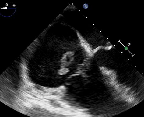 Enlarged Heart – Explained By A Cardiologist • MyHeart Enlarged Heart, Heart Muscle, Lungs, Health Issues, Health