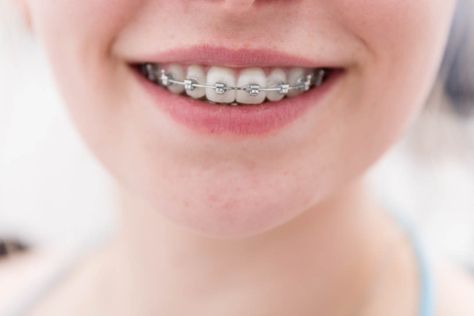 With my assistance and expertise you'll be on your way to a brighter healthier smile in no time! #CosmeticDentist #TeethWhiteningService #DentalVeneers https://bit.ly/3eRSROe Teeth After Braces, After Braces, Braces Cost, Types Of Braces, Braces Off, Dental Aesthetics, Braces Girls, Dental Check Up, Clear Braces