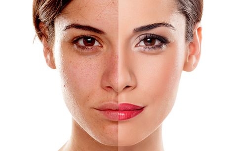 Laser Photo Rejuvenation Removes Vascular lesions, rosacea, spider veins, age spots, sun damages, brown spots, and general skin freshness. Passport Photo Makeup, Age Spots On Face, Skin Care Routine For 20s, Dark Spots On Face, Whitening Face, Spots On Face, Skin Remedies, Skin Care Remedies, Photo Makeup