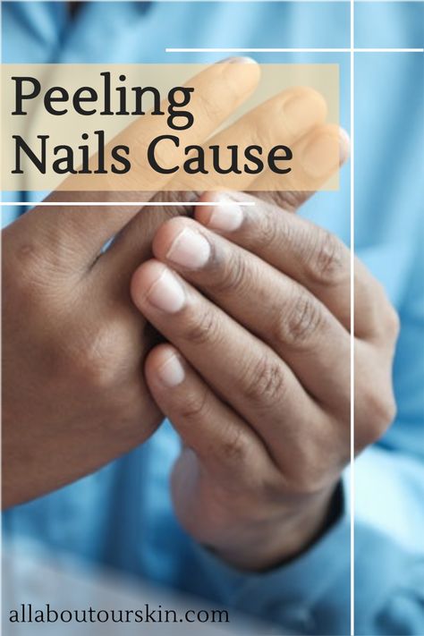 If you have a career as a hairstylist or cleaner, you may be very familiar with this situation. Constantly having your hands in water can cause brittle, split or peeling nails. Repetitive wetting and drying of hands are the most common reason for peeling nails. What To Do For Brittle Nails, Why Are My Nails Peeling, Brittle Nails Causes, Nail Splitting Remedies, Nail Repair Split, Split Nails Remedies, Dry Nails Remedy, Splitting Nails Remedies, Peeling Nails Remedy