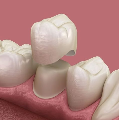 Zirconia Crowns Teeth, Crown Teeth, Teeth Crown, Dental Content, Teeth Images, Tooth Crown, Dental Images, Tooth Filling, Dental Social Media