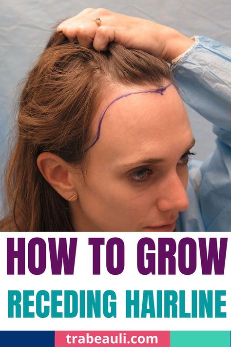 receding hairline style Hair Growth For Receding Hairline, Hairstyles For Women With Receding Hair, Female Receding Hairline, How To Fix Hairline Women, Types Of Hairlines Women, How To Grow Receding Hair Line, Women Receding Hairline Hairstyles, How To Get A Better Hairline, Hair Styles For Receding Hairline Women