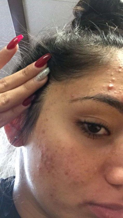 PHOTO: Karina Banuelos, 17, shared this photo of her severe acne before she cleared it up with a skincare routine featuring four cheap products. Remedies For Acne And Pimples, Make Up On Acne Skin, Teen Acne Skincare Routine, Acne Friendly Makeup, Yeast Acne, Under Skin Acne, How To Clear Up Acne, Acne Images, Acne Photos