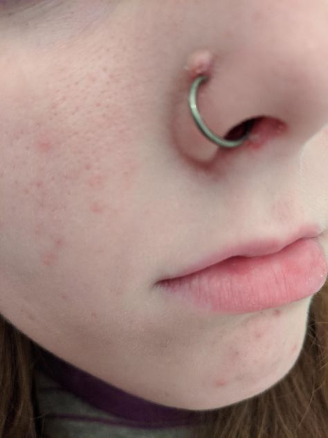 Nose Piercing Irritation Bump, Bump On Nose Piercing, Nose Bump, Nose Piercing Scar, Nose Peircing, Nose Piercing Bump, Piercing Bump, Piercing Nose, The Bump