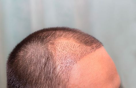 When Is The Right Time To Have A Hair Transplant How To Contour Your Face, Hair Transplant Surgery, Herbal Hair, Laser Therapy, Hair Starting, Hair Scalp, Modern Hairstyles, One Hair, Hair Transplant