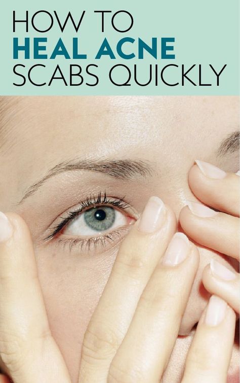 Here's the easiest and quickest way to heal your acne scabs. #howtocoverupacne #healacnescabs #coverupacnescabs #acnescars Scab On Face, Scab Healing, Acne Scab, Cat Eye Makeup, How To Get Rid Of Acne, Fall Makeup, Smokey Eye Makeup, Skin Tips, How To Apply Makeup