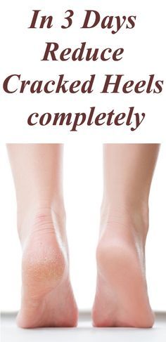 Cracked Heels Diy, Cracked Feet Remedies, Nails Remedies, Remedies For Cracked Heels, Heal Cracked Heels, Cracked Heel Remedies, Feet Remedies, Dry Heels, Dry Cracked Heels