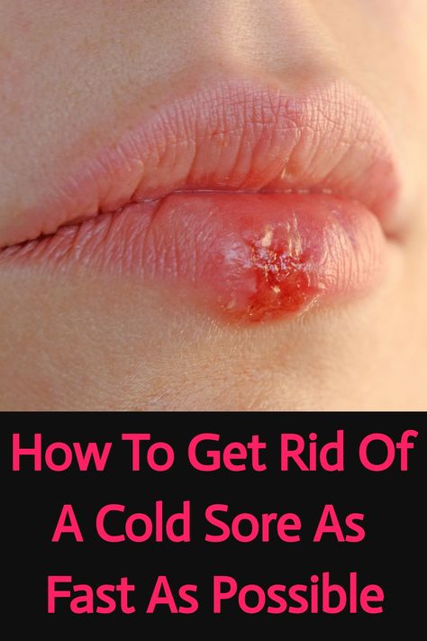 Save this pin to learn how to get rid of a cold sore with remedies and prevention tips from a lifelong cold sore sufferer! From effective treatments to practical prevention strategies, discover the best ways to manage and prevent cold sores. Cover Up Cold Sore, Cold Sore Remedy Fast, Cold Sore Remedy Overnight, Cold Sore Lip, Cold Sore Remedies, Cold Sore Prevention, Home Remedies For Cold, Cold Sore Relief, Coldsore Remedies Quick