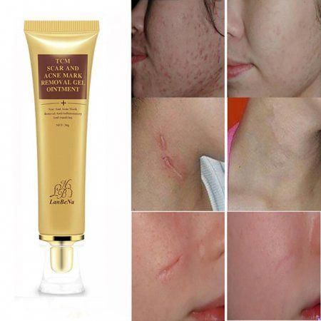 Arrives by Wed, Nov 30 Buy 30g Scar Acnes Keloid Repairs Stretch Gel Cream Marks Skin Burns Removal Cream at Walmart.com Acne Scar Cream, Acne Mark Removal, Acne Scar Removal Cream, Scar Removal Cream, Face Pores, Scar Cream, Skin Burns, Stretch Mark Cream, Acne Scar