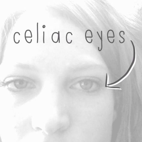 Celiac Eyes, Celiac Awareness, Gluten Free Info, Coeliac Disease, Going Gluten Free, Gluten Free Living, Gluten Sensitivity, Gluten Intolerance, Foods With Gluten