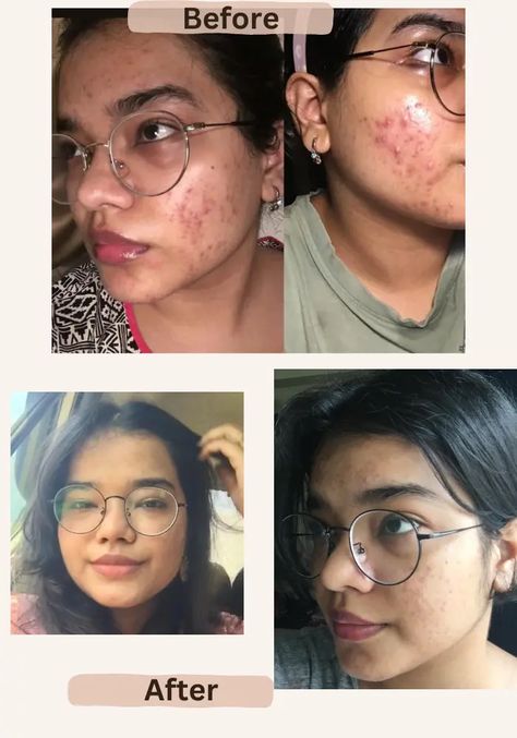 Tretinoin Before And After, Closed Comedones, People With Acne, Layers Of The Epidermis, Skincare Inspiration, Benzoyl Peroxide, Progress Pictures, Best Skin, How To Treat Acne