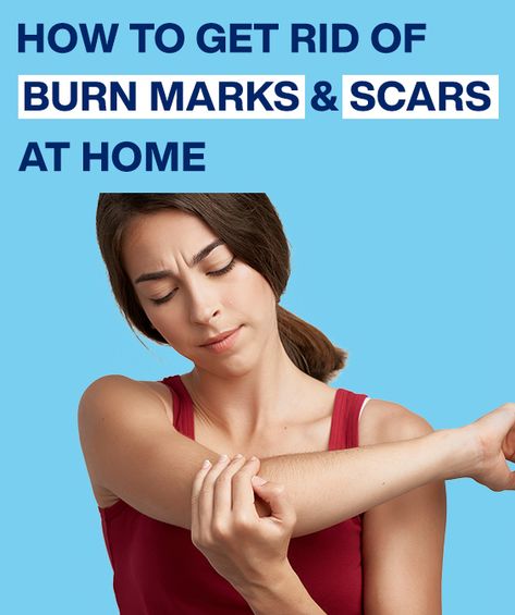 How To Get Rid Of A Burn On Skin, How To Remove Burn Marks On Skin, How To Heal Burned Skin, Burn Mark On Skin, What To Put On Burns On Skin, Burn Scar Remedies, How To Get Rid Of Scars, Burned Skin Remedies, Burn Scar Removal