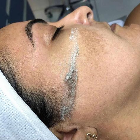 Dermaplaning Aesthetic, Dermaplaning Before And After, Girl Esthetics, Dermaplaning At Home, Lab Aesthetic, Dermaplaning Facial, Esthetician Marketing, Medical Aesthetics, Facial Aesthetics