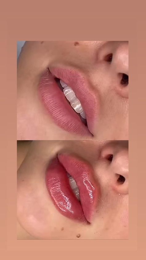 Lip Filler Round Lips, 2 Ml Lip Filler, Doll Lips Filler, Lip Fillers Inspiration, Juvederm Before And After Lips, 1 Ml Lip Filler Before And After, Pouty Lip Filler, Russian Lips Filler, 0.5 Ml Lip Filler Before And After