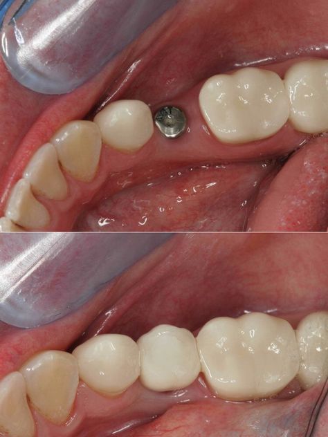 Dental implants are the preferred method of replacing a missing tooth because you can brush and floss around it more easily than a bridge. Dental Bridge Cost, Implants Dental, Tooth Extraction Aftercare, Tooth Extraction Healing, Tooth Implant, Affordable Dental Implants, Dental Implant Procedure, Bridge House, Dental Implants Cost