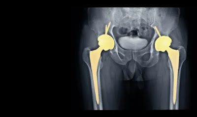 What I wish I knew before hip replacement surgery? Having a hip replacement surgery can be an intimidating experience. You may be wondering what the surgery entails, what to expect before and after, and what activities you should avoid to ensure a successful surgery. This article is here to provide you with the insight and advice you need before embarking on a hip replacement journey.We will discuss why it is important to know what to expect before hip replacement surgery, what to consider wh... Total Hip Surgery, Hip Surgery Recovery, Psoas Release, Hip Surgery, Surgery Recovery, Nerve Damage, Alternative Treatments, Post Surgery, I Wish I Knew