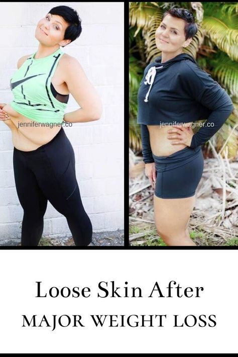 Lower Body Lift Surgery Before And After, Lower Body Lift Surgery, Body Lift Surgery, Skin Removal Surgery, Bariatric Sleeve, 160 Pounds, Tighten Loose Skin, Extra Skin, Excess Skin