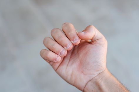 Hope for Nail Biters? Can Bitten Nails Grow Back To Normal? Bitten Nails Before And After, Short Bitten Nails, Biting Fingernails, Bitten Nails, Nail Biting Habit, Ingrown Nail, Fun Nail Colors, Nail Bed, Nail Biting