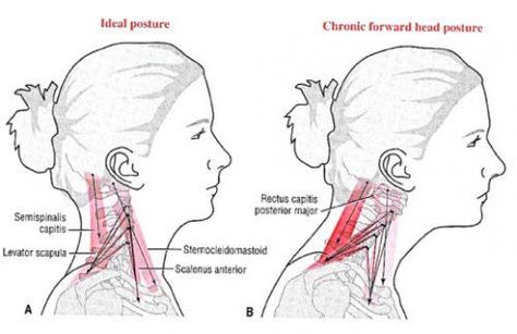 Shoulder Raises, Text Neck, Neck Problems, Forward Head Posture, Pinched Nerve, Shoulder Muscles, Body Posture, Poor Posture, Chest Pain