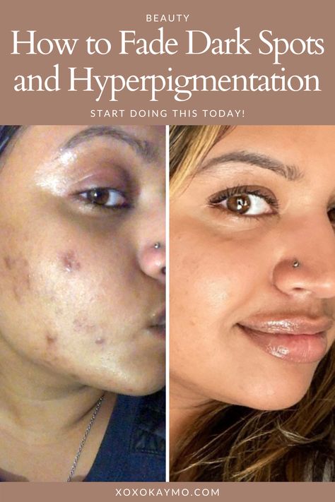 How to Fade Dark Spots and Hyperpigmentation Acne happens, and sometimes we have the scars left over to prove it. If you have darker skin tones, acne blemishes tend to linger long after the pimple disappears. There are products and methods you can implement today to get rid of these dark spots and hyperpigmentation quick. How To Get Rid Of Acne And Dark Spots, How To Remove Blemishes From Face, Dark Acne Spots Remedies, Hyper Pigmentation On Face, Best Skin Care Products For Acne Dark Spots, Pimple Scar Removal Dark Spots, How To Remove Hyperpigmentation On Face, Blemishes On Face Remedies, Get Rid Of Dark Spots On Face