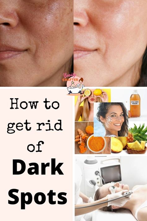 dark spots treatment collage Age Spots On Face, Age Spot Removal, Dark Spots On Face, Product Ingredients, Brown Spots Removal, Brown Spots On Face, Skin Spots, Spots On Face, Baking Soda Shampoo