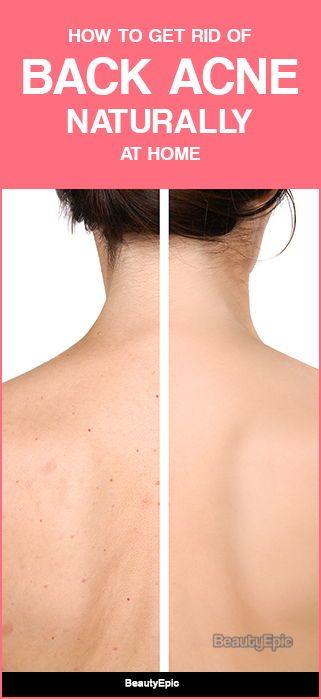 If you are victim of back acne, we brought you some solution to solve them all with herbal remedies. Let us read to know some effective ways on how to get rid of back acne naturally. Back Acne Remedies Diy, How To Treat Back Acne At Home, Get Rid Of Back Acne, Rid Of Back Acne, Back Acne Remedies, Pimples Under The Skin, Back Acne, Pimples Overnight, Natural Acne Remedies